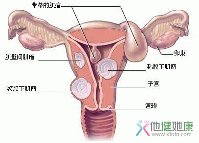 [广东罗定市一女子]一女子竟产下78枚子宫肌瘤