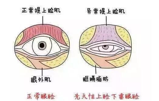 这么明显的大小眼，靠割双眼皮能不能矫正不对称的双眼