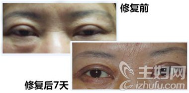 姜洪涛主任：双眼皮修复需因“眼”而异