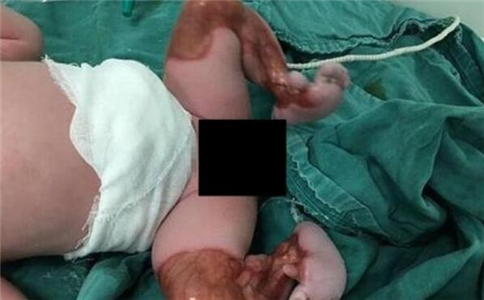新生儿双腿透明 新生儿双腿透明怎么回事 新生儿先天性皮肤发育不全
