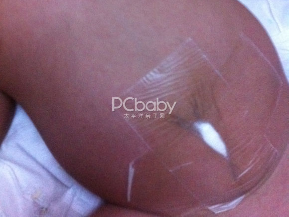 新生儿脐带护理