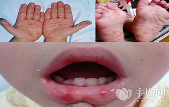 手足口病和幼儿急疹的区别