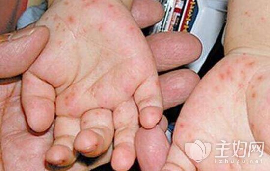 手足口病和幼儿急疹的区别