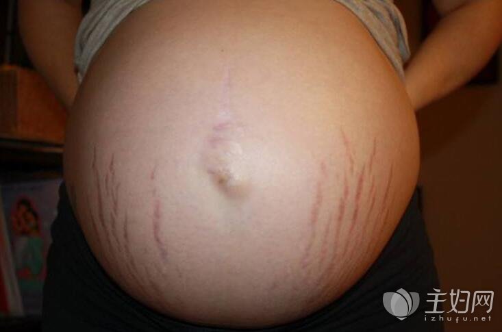 缓解和减轻妊娠纹的10个方法