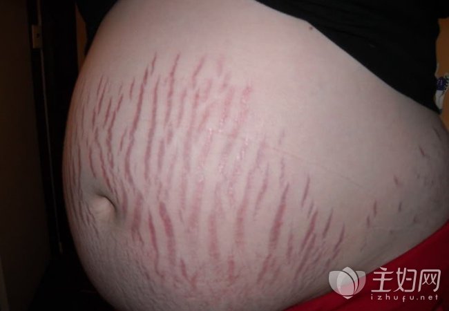 产后妊娠纹多怎么办 减少妊娠纹的方法