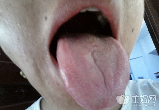 舌头有裂痕是怎么回事 有裂痕后应该这样做